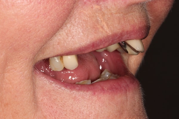 Before Invisalign Treatment Smile Rooms Glasgow