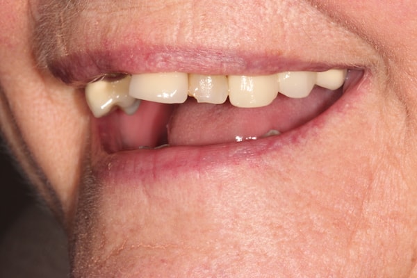 Before Invisalign Treatment Smile Rooms Glasgow
