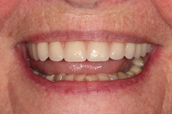 After Invisalign Treatment Smile Rooms Glasgow