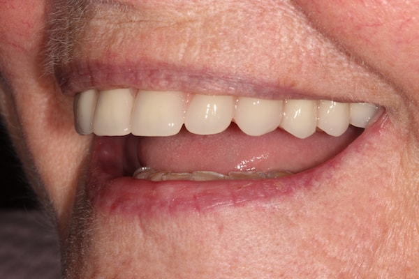 After Invisalign Treatment Smile Rooms Glasgow