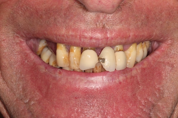 Before & After Dental Implants