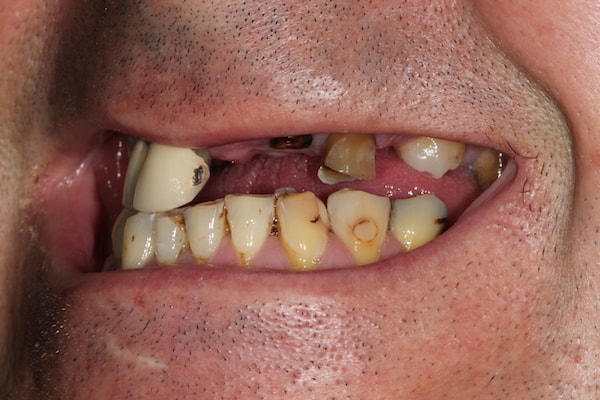 Before Invisalign Treatment Smile Rooms Glasgow