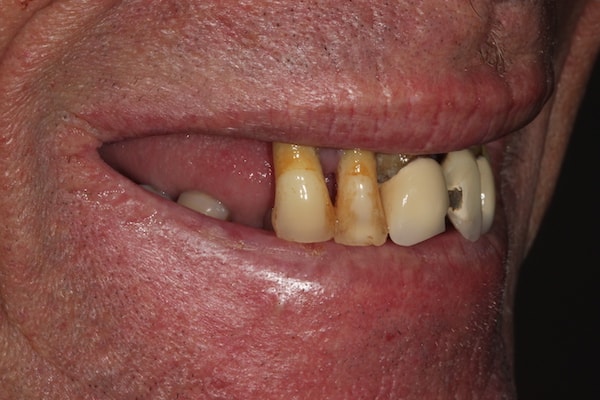 Before & After Dental Implants