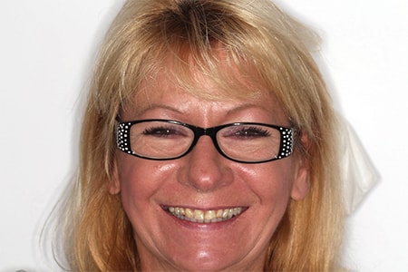 Before Smile Makeover Treatment Smile Rooms Glasgow Before Smile Makeover Treatment Smile Rooms Glasgow