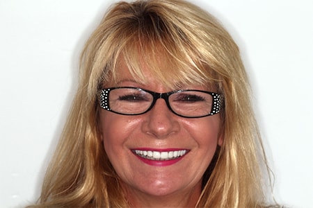 After Smile Makeover Treatment Smile Rooms Glasgow After Smile Makeover Treatment Smile Rooms Glasgow