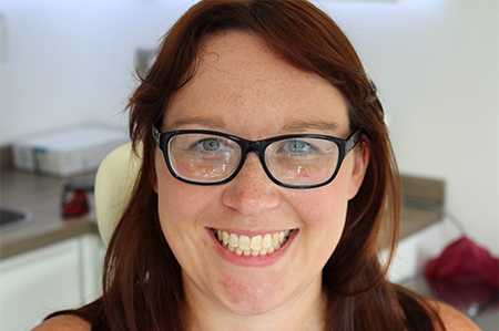 Before Invisalign Treatment Smile Rooms Glasgow Before Invisalign Treatment Smile Rooms Glasgow