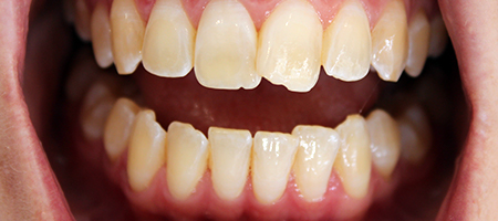 Before Invisalign Treatment Smile Rooms Glasgow Before Invisalign Treatment Smile Rooms Glasgow