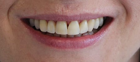 After Invisalign Treatment Smile Rooms Glasgow