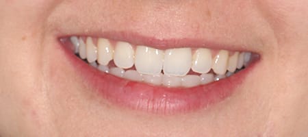 After Invisalign Treatment Smile Rooms Glasgow After Invisalign Treatment Smile Rooms Glasgow