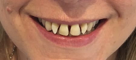 Before Invisalign Treatment Smile Rooms Glasgow