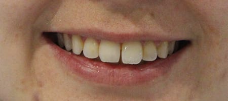 Before Invisalign Treatment Smile Rooms Glasgow Before Invisalign Treatment Smile Rooms Glasgow