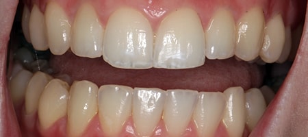 After Invisalign Treatment Smile Rooms Glasgow After Invisalign Treatment Smile Rooms Glasgow