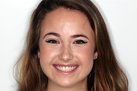 After Invisalign Treatment Smile Rooms Glasgow After Invisalign Treatment Smile Rooms Glasgow