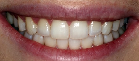 After Invisalign Treatment Smile Rooms Glasgow After Invisalign Treatment Smile Rooms Glasgow