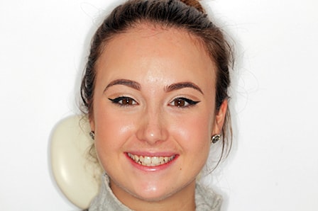 Before Invisalign Treatment Smile Rooms Glasgow Before Invisalign Treatment Smile Rooms Glasgow