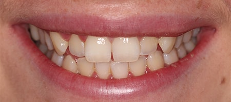 Before Invisalign Treatment Smile Rooms Glasgow Before Invisalign Treatment Smile Rooms Glasgow