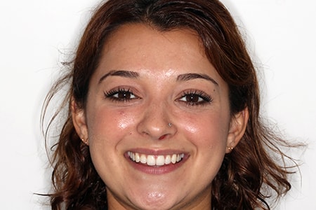 After Invisalign Treatment Smile Rooms Glasgow After Invisalign Treatment Smile Rooms Glasgow