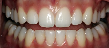 After Invisalign Treatment Smile Rooms Glasgow After Invisalign Treatment Smile Rooms Glasgow