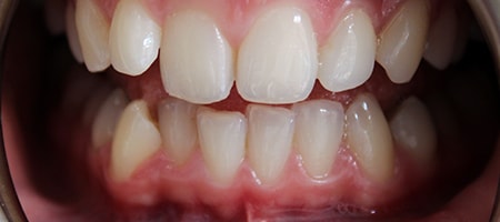 Before Invisalign Treatment Smile Rooms Glasgow Before Invisalign Treatment Smile Rooms Glasgow