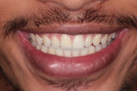 After Smile Makeover Treatment Smile Rooms Glasgow After Smile Makeover Treatment Smile Rooms Glasgow