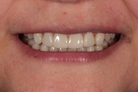 After Veneers Treatment Smile Rooms Glasgow After Veneers Treatment Smile Rooms Glasgow