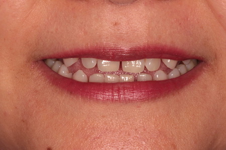 Before veneers Treatment Smile Rooms Glasgow Before veneers Treatment Smile Rooms Glasgow