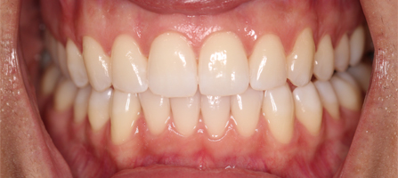 After Invisalign Treatment Smile Rooms Glasgow After Invisalign Treatment Smile Rooms Glasgow