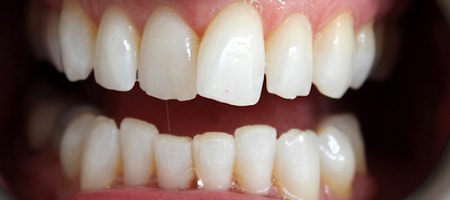 Before Invisalign Treatment Smile Rooms Glasgow Before Invisalign Treatment Smile Rooms Glasgow