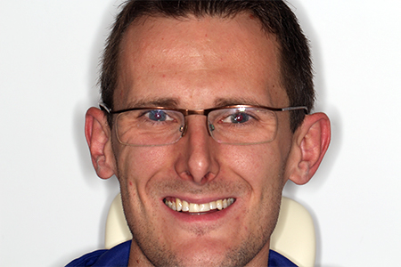 After Invisalign Treatment Smile Rooms Glasgow After Invisalign Treatment Smile Rooms Glasgow