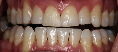 After Invisalign Treatment Smile Rooms Glasgow After Invisalign Treatment Smile Rooms Glasgow