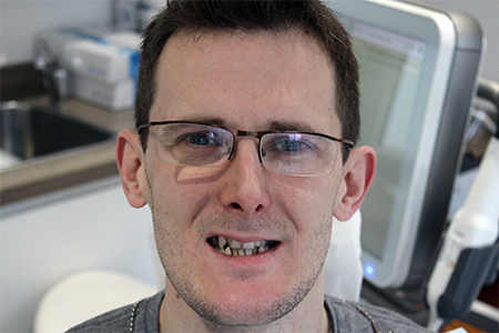 Before Invisalign Treatment Smile Rooms Glasgow Before Invisalign Treatment Smile Rooms Glasgow