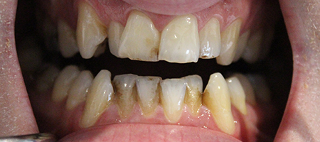 Before Invisalign Treatment Smile Rooms Glasgow Before Invisalign Treatment Smile Rooms Glasgow