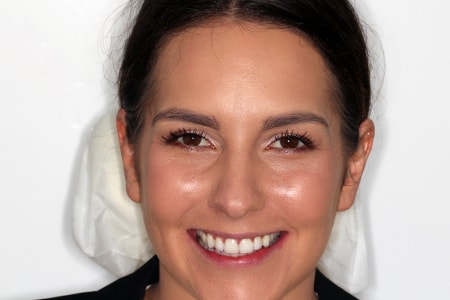 After Invisalign Treatment Smile Rooms Glasgow After Invisalign Treatment Smile Rooms Glasgow