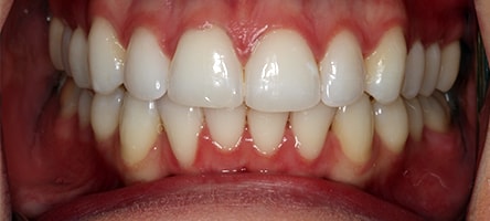 After Invisalign Treatment Smile Rooms Glasgow After Invisalign Treatment Smile Rooms Glasgow