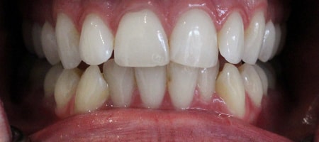 Before Invisalign Treatment Smile Rooms Glasgow Before Invisalign Treatment Smile Rooms Glasgow