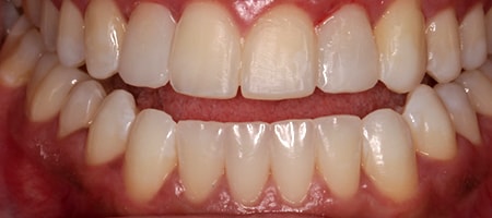 After Invisalign Treatment Smile Rooms Glasgow After Invisalign Treatment Smile Rooms Glasgow