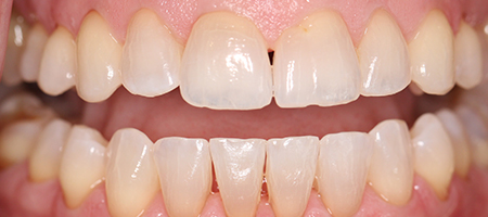 After Invisalign Treatment Smile Rooms Glasgow After Invisalign Treatment Smile Rooms Glasgow