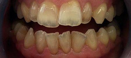 Before Invisalign Treatment Smile Rooms Glasgow Before Invisalign Treatment Smile Rooms Glasgow
