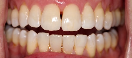 After Invisalign Treatment Smile Rooms Glasgow After Invisalign Treatment Smile Rooms Glasgow