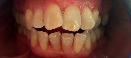 Before Invisalign Treatment Smile Rooms Glasgow Before Invisalign Treatment Smile Rooms Glasgow