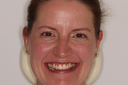 After Invisalign Treatment Smile Rooms Glasgow After Invisalign Treatment Smile Rooms Glasgow