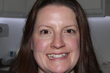 Before Invisalign Treatment Smile Rooms Glasgow Before Invisalign Treatment Smile Rooms Glasgow