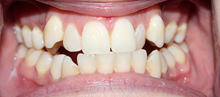 Before Invisalign Treatment Smile Rooms Glasgow Before Invisalign Treatment Smile Rooms Glasgow