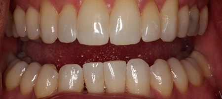 After Invisalign Treatment Smile Rooms Glasgow After Invisalign Treatment Smile Rooms Glasgow