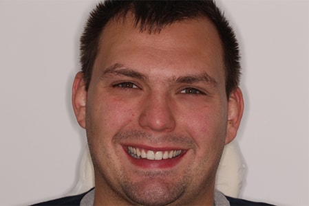 After Invisalign Treatment Smile Rooms Glasgow After Invisalign Treatment Smile Rooms Glasgow