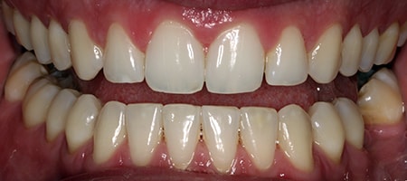After Invisalign Treatment Smile Rooms Glasgow After Invisalign Treatment Smile Rooms Glasgow