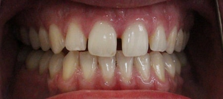 Before Invisalign Treatment Smile Rooms Glasgow Before Invisalign Treatment Smile Rooms Glasgow