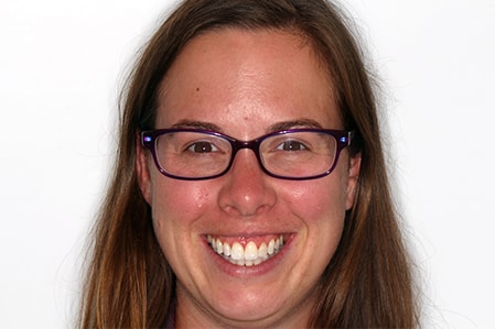 After Invisalign Treatment Smile Rooms Glasgow After Invisalign Treatment Smile Rooms Glasgow