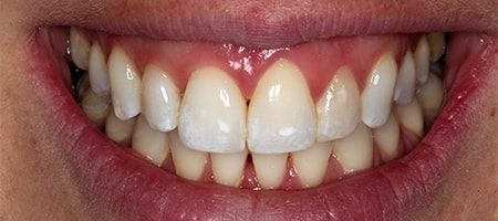 After Invisalign Treatment Smile Rooms Glasgow After Invisalign Treatment Smile Rooms Glasgow