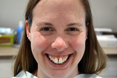 Before Invisalign Treatment Smile Rooms Glasgow Before Invisalign Treatment Smile Rooms Glasgow